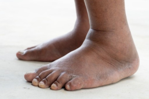 Swollen Feet and Ankles and When to Seek Podiatric Care