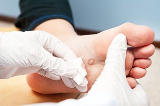 Plantar Warts and Their Causes