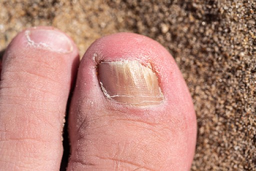 How to Treat Your Toenail Fungus