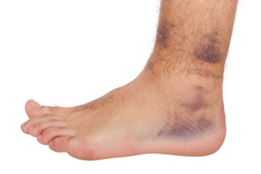 Ankle Sprains
