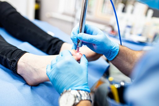Laser Treatment for Fungal Nails