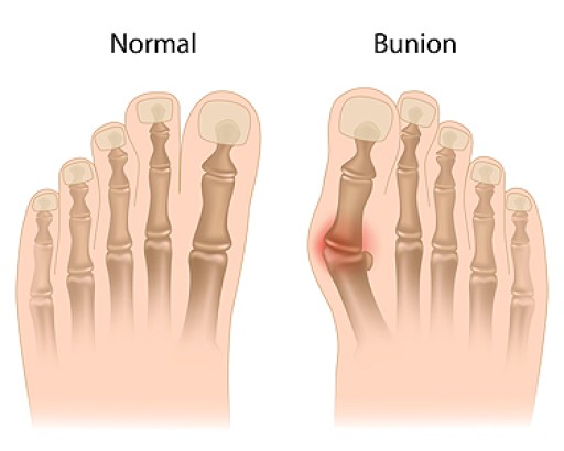 Bunions