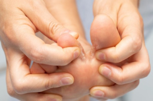 What Is Severe Athlete’s Foot?