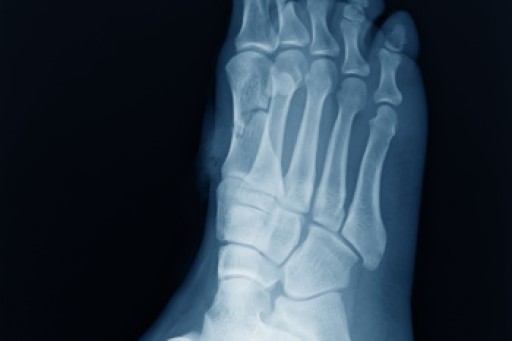 All About Cuboid Syndrome