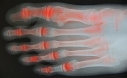 Treating Painful Symptoms of Rheumatoid Arthritis