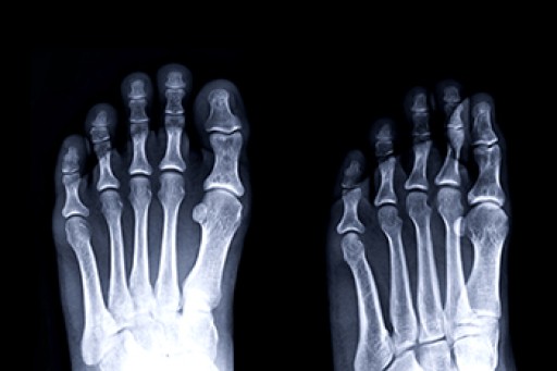 What Is a Metatarsal Fracture?