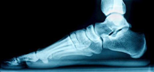 Flat Feet