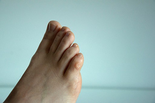 Managing Corns and Calluses